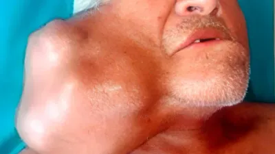 Fotografía clínica de tumor mixto benigno en glándula parótida