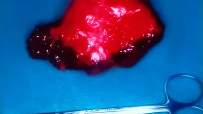 Pieza quirúrgica resecada de tumor de glándula parótida