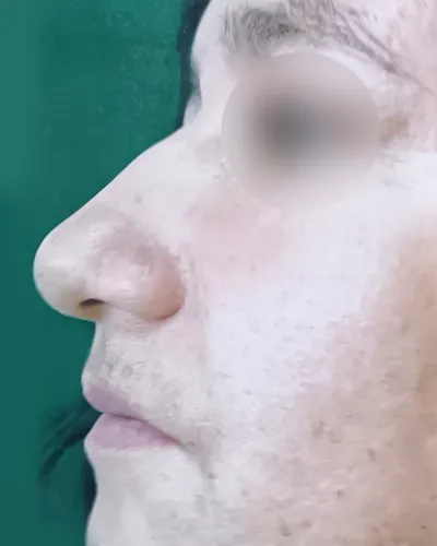 Fotografía clínica inicial (Antes) de rinoplastia estética y funcional