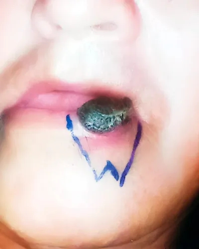 Fotografía clínica de lesión tumoral de cáncer de labio en cavidad oral