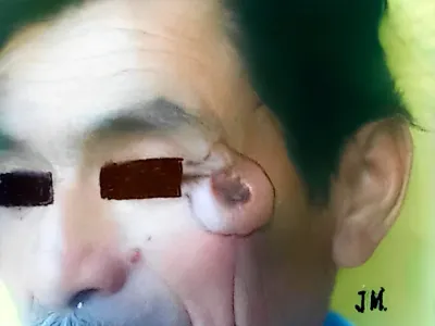 Fotografía clínica de cáncer de piel en región malar