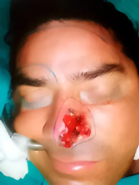 Fotografía clínica de excisión radical y reconstrucción con colgajo frontal en cáncer cutáneo de nariz