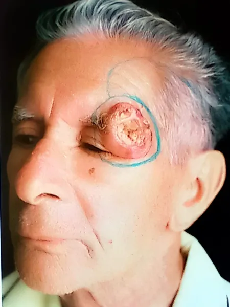Fotografía clínica de excisión radical y reconstrucción mediante colgajo de rotación en región periorbitaria