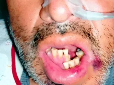 Fotografía clínica de fractura mandibular tratada quirúrgicamente