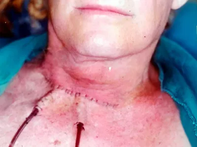 Fotografía clínica de seguimiento posoperatorio de tumor de tiroides