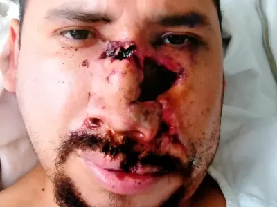 Fotografía clínica de reconstrucción por traumatismo maxilofacial